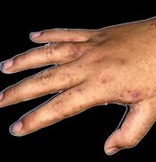 Image result for Canine Scabies