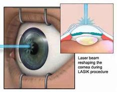 Image result for Refractive Surgery