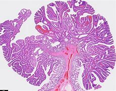 Image result for Colon Polyps Histology