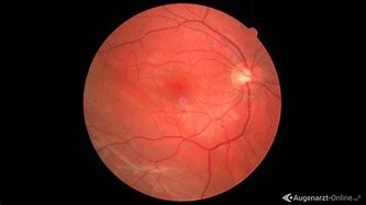 Image result for Ablatio Retina Vision