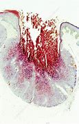 Image result for Molluscum Contagiosum Back Acne
