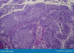 Image result for Transitional Cell Carcinoma