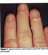 Image result for Molluscum Contagiosum Finger
