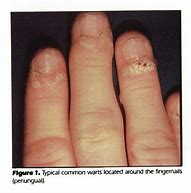 Image result for Mollescum Contagiosum in Hands