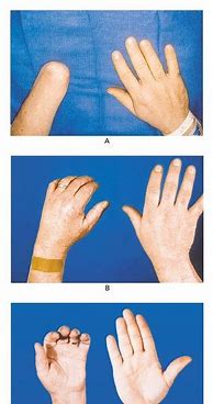 Image result for hand transplant