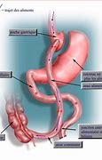 Image result for Bypass Gastrique