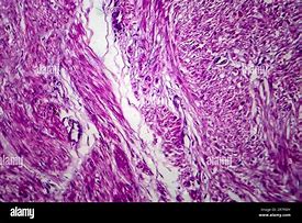 Image result for Large Uterine Fibroid