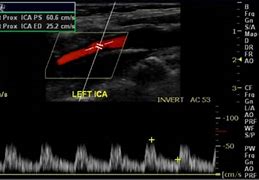 Image result for Internal Carotid Artery Ultrasound