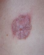 Image result for Genital Skin Cancer