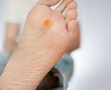Image result for Pressure Ulcer On Bottom of Foot