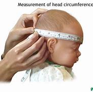 Image result for Hydrocephalus Head Circumference Adults