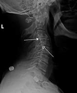 Image result for Minimal Grade 1 Anterolisthesis of C4 On C5