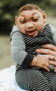 Image result for Baby with Microcephaly