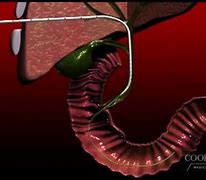 Image result for Biliary Drain Care