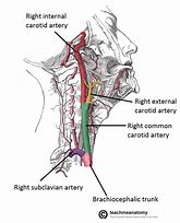 Image result for Proximal Internal Carotid Artery