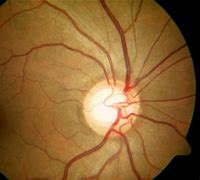 Image result for glaucomatoso