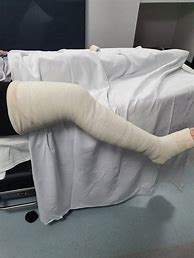 Image result for Broken Knee Cast