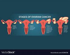Image result for Ovarian Cancer Stages
