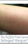 Image result for Allergic Reaction Rash to Laundry Detergent