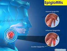 Image result for epiglotis