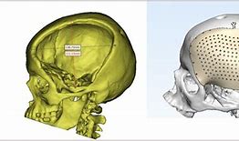 Image result for Cranial Repair for Encefalocel