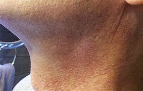 Image result for Skin Cancer Rash Neck