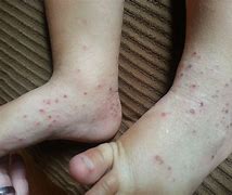 Image result for What Does Atopic Dermatitis Look Like