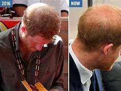 Image result for prince harry hair loss