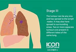 Image result for Lung Cancer Hip Pain