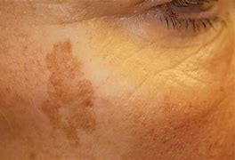 Image result for Sun Spots vs Skin Cancer