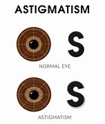 Image result for Eye Astigmatism Symptoms