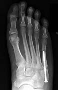 Image result for 5th Metatarsal Fracture Boot