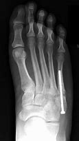 Image result for Non-Union 5th Metatarsal Fracture