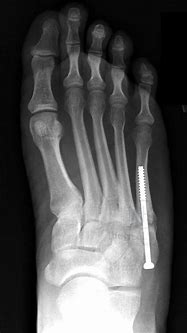 Image result for Fifth Metatarsal Pain