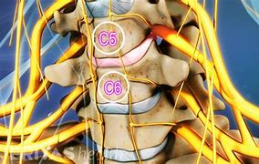 Image result for C5 and C6 Bulging Disc