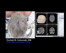 Image result for Meningioma Brain Tumor Surgery