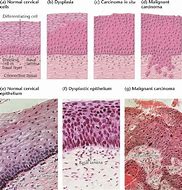 Image result for Cervical Cancer Histology