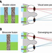 Image result for Vertical Double Vision