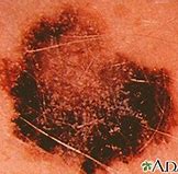 Image result for Que ES El Melanoma