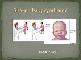 Image result for Shaken Baby Syndrome Pictures