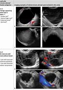 Image result for Complex Adnexal Cyst