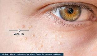 Image result for Cure for Warts On Face