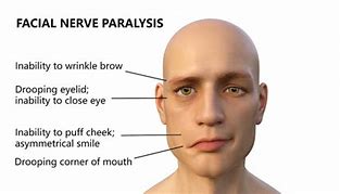 Image result for Peripheral Facial Nerve Palsy
