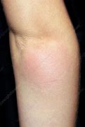 Image result for Allergic Reaction to Mosquito Bites