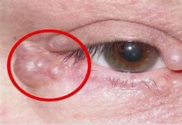 Image result for Cyst Under Eyelid