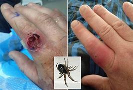Image result for False Widow Spider Bite