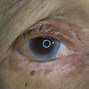 Image result for Wart On Upper Eyelid