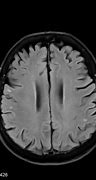 Image result for Transient Global Amnesia