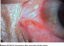 Image result for Caruncle Papilloma