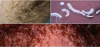 Image result for Trichomoniasis Rash